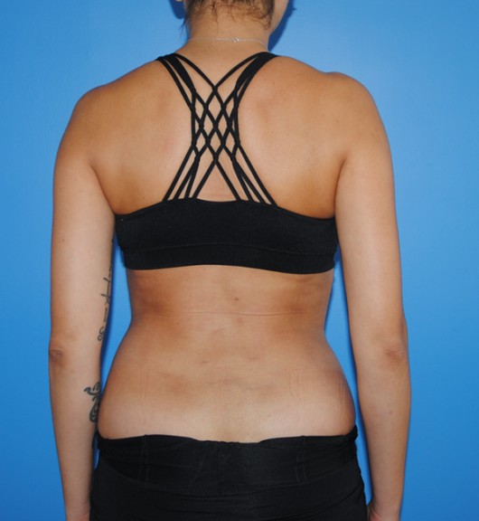 Liposuction after — Dr. Brian Dickinson