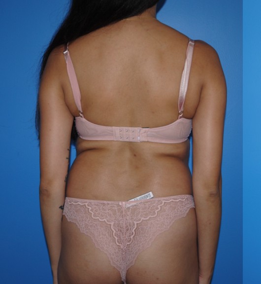 Liposuction before — Dr. Brian Dickinson