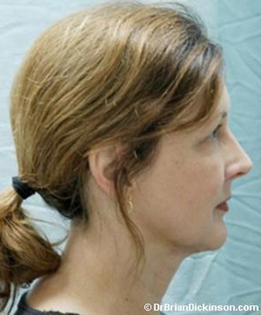 Liposuction after — Dr. Brian Dickinson