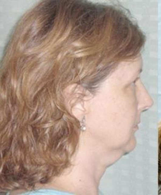 Liposuction before — Dr. Brian Dickinson
