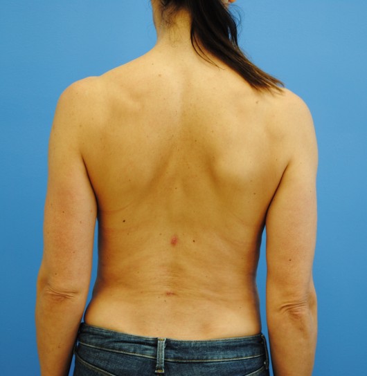 Liposuction after — Dr. Brian Dickinson