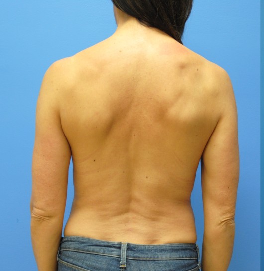 Liposuction before — Dr. Brian Dickinson