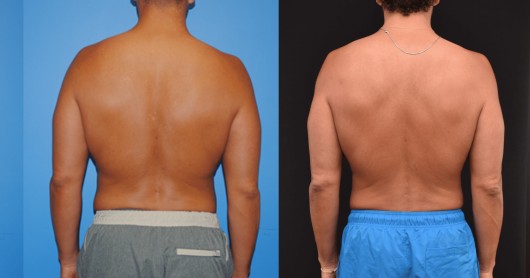 Liposuction after — Dr. Brian Dickinson
