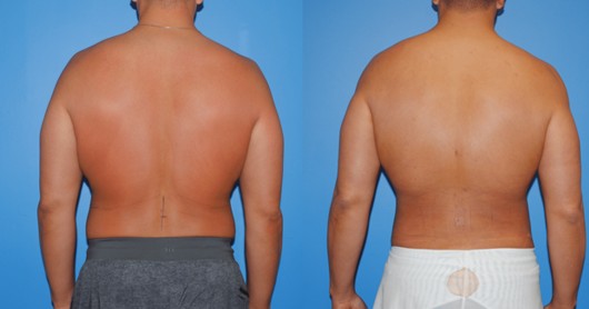 Liposuction before — Dr. Brian Dickinson