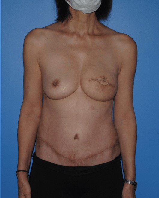 Procedure before and after - after