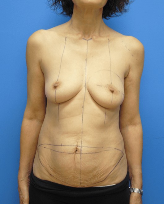 Procedure before and after - before