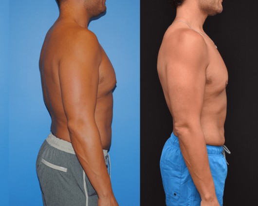 Liposuction after — Dr. Brian Dickinson