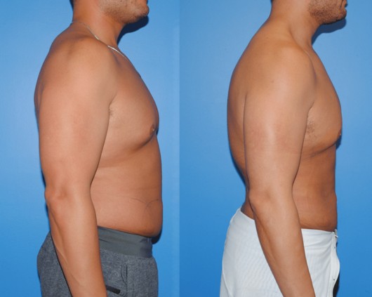 Liposuction before — Dr. Brian Dickinson