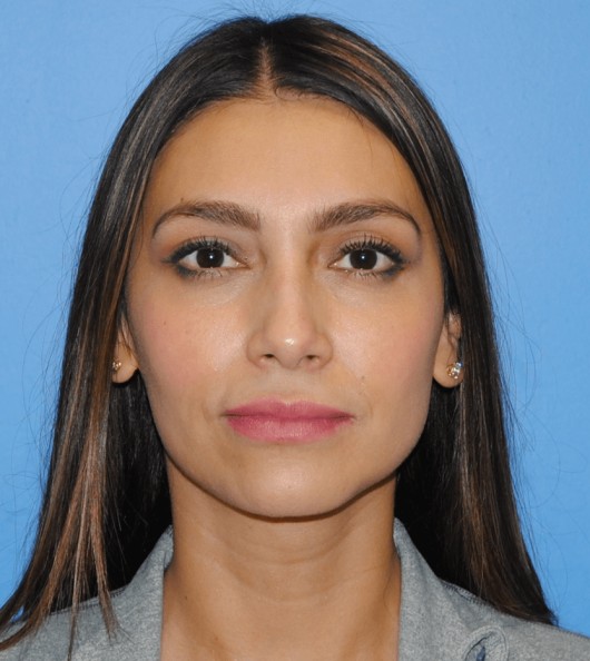 Lower Blepharoplasty before and after - after