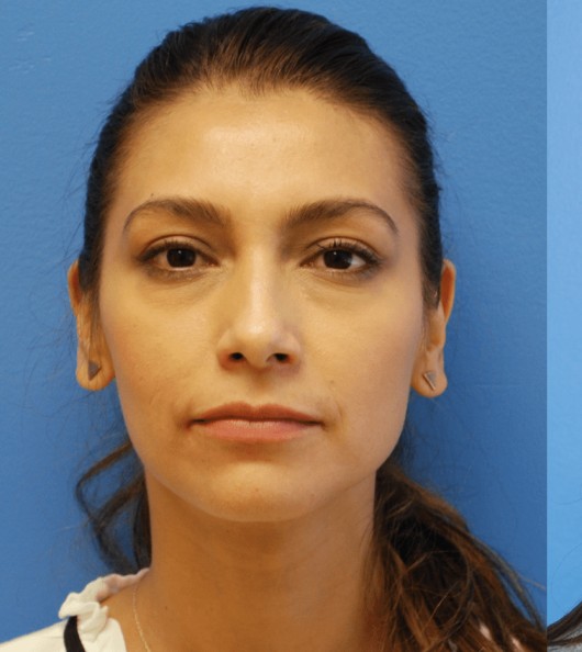Lower Blepharoplasty before and after - before