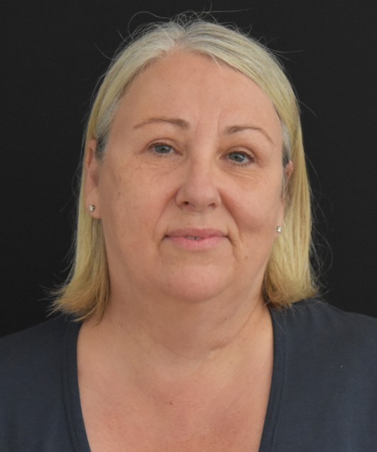Upper Blepharoplasty before and after - after