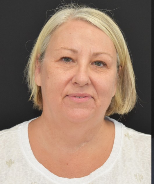Upper Blepharoplasty before and after - before