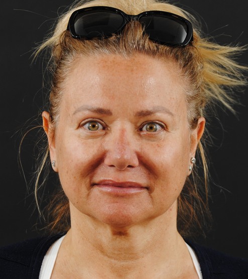 Rhinoplasty and Blepharoplasty before and after - after