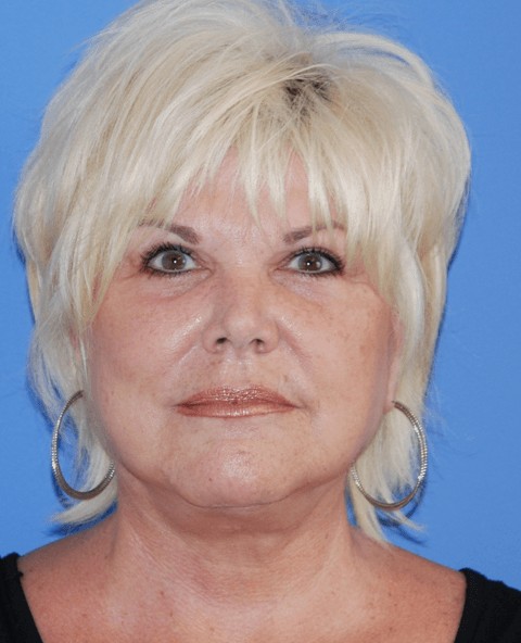 Facelift after — Dr. Brian Dickinson