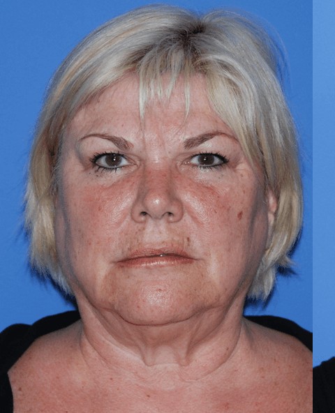 Facelift before — Dr. Brian Dickinson