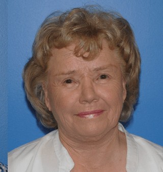 Facelift after — Dr. Brian Dickinson