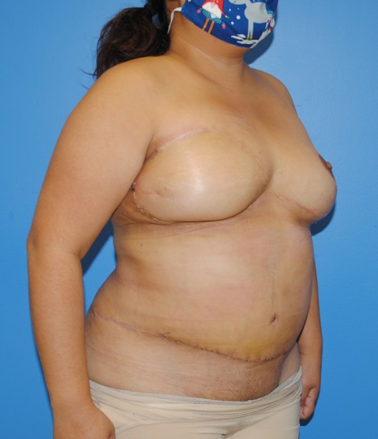 Procedure before and after - after