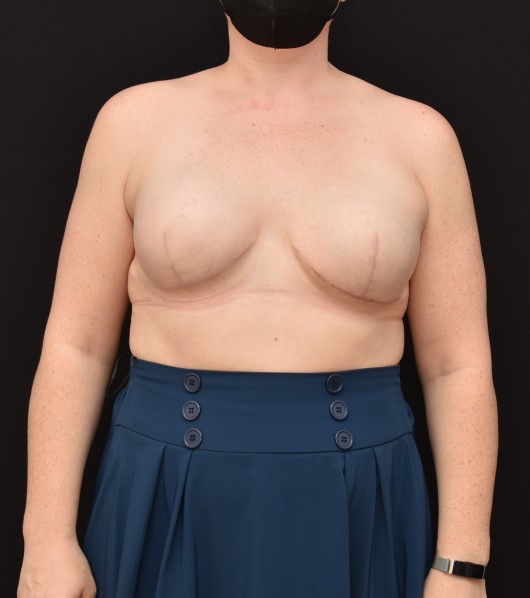 Procedure before and after - after