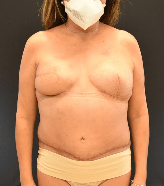 Procedure before and after - after