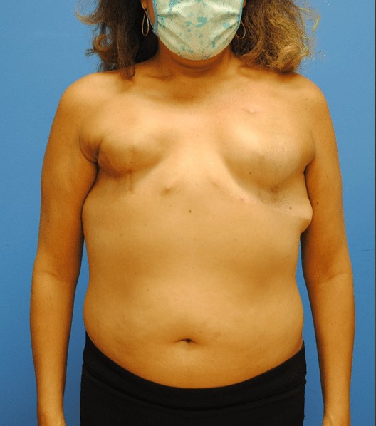 Procedure before and after - before