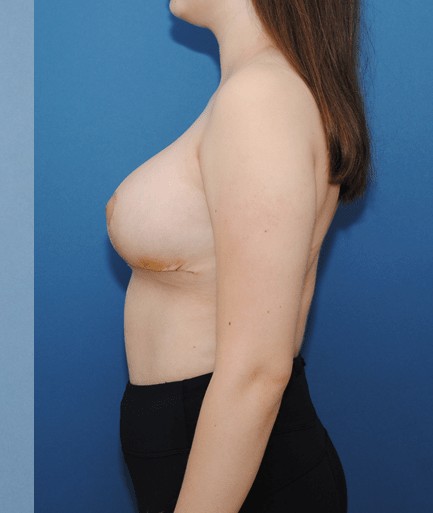Breast Reduction before and after - after