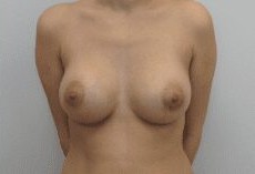 Breast Procedures before and after - after