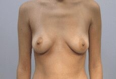 Breast Procedures before and after - before