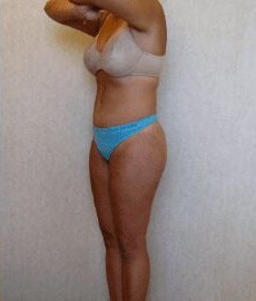 Tummy Tuck & Liposuction before and after - after