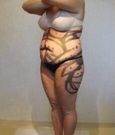 Tummy Tuck & Liposuction before and after - before