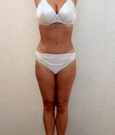 Tummy Tuck & Liposuction before and after - after