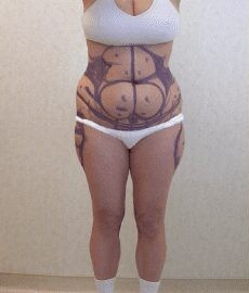 Tummy Tuck & Liposuction before and after - before