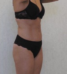 Tummy Tuck & Liposuction before and after - after