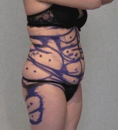 Tummy Tuck & Liposuction before and after - before