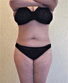 Liposuction Only before and after - after