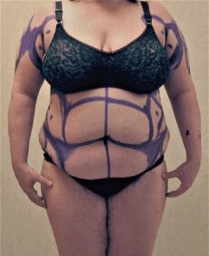 Liposuction Only before and after - before