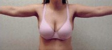 Liposuction Only before and after - after