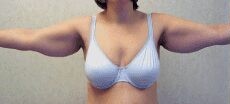 Liposuction Only before and after - before