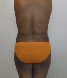 Liposuction Only before and after - after