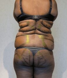 Liposuction Only before and after - before