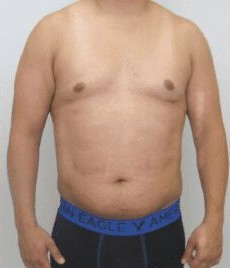Liposuction Only before and after - after