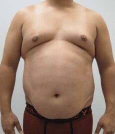Liposuction Only before and after - before