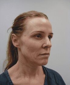 Facelift before and after - before