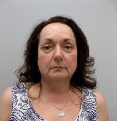 Facelift before and after - before