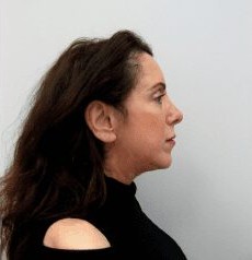 Facelift before and after - after