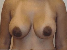 Breast Procedures before and after - after