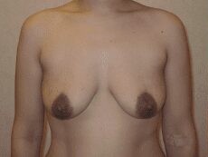 Breast Procedures before and after - before
