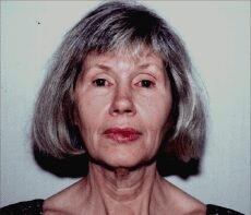 Facelift before and after - before