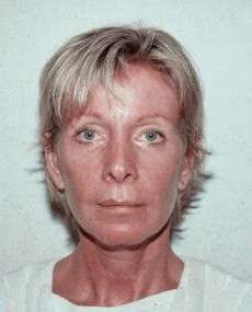 Facelift before and after - after