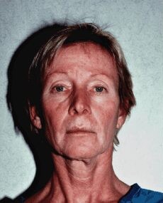 Facelift before and after - before