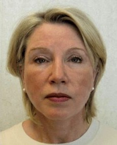 Facelift before and after - after